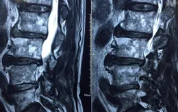 Nguyên nhân và triệu chứng bệnh thoát vị đĩa đệm