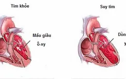 7 điều ít biết về bệnh suy tim