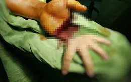 Nối bàn tay thành công cho bệnh nhân bị chém lìa