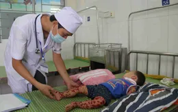 Bắc Ninh: gia tăng bệnh tay chân miệng ở trẻ nhỏ