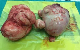 Cắt u xơ tử cung 4,5kg cho bệnh nhân tâm thần