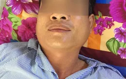 Cả gia đình bị quai bị, con trai biến chứng nguy hiểm