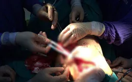Cắt và tạo hình tuyến vú điều trị ung thư vú giai đoạn sớm