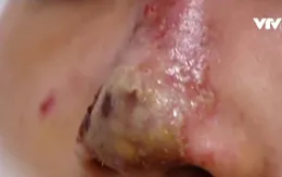 Tiêm filler làm đẹp: Cẩn thận rước họa vào thân