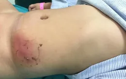 Mẹ dán cao trị mụn, con bị hoại tử da vùng bụng