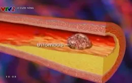 Những biến chứng của bệnh động mạch vành