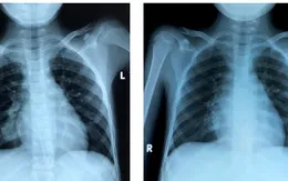 Suýt vỡ động mạch phổi do bệnh hiếm