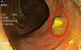 Suýt thủng ruột vì nuốt phải răng giả hơn 2 tháng