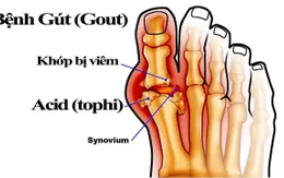 Phụ nữ chớ chủ quan với bệnh gout