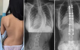 Bệnh cong vẹo cột sống ở trẻ