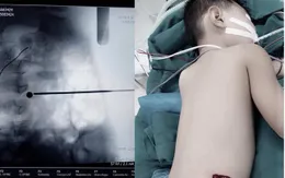 Bé trai 5 tuổi bị súng hơi bắn thủng hông