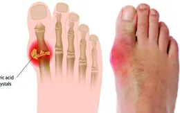 Nguy cơ tử vong cao khi bị đau tim đối với bệnh nhân gout