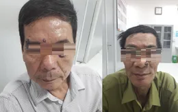 Tới bệnh viện đốt nốt ruồi - Phát hiện bị ung thư tế bào đáy