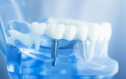 Bạn hiểu cấy ghép răng Implant là như thế nào không?