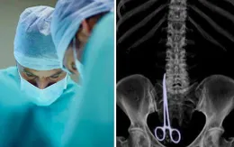 Bác sĩ để quên kéo phẫu thuật trong bụng bệnh nhân
