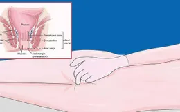Hậu môn chảy nước - coi chừng ung thư