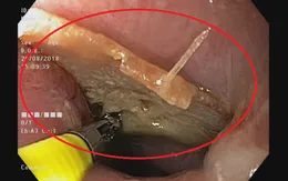 Xem bóng đá, người đàn ông nuốt chửng mảnh xương cá