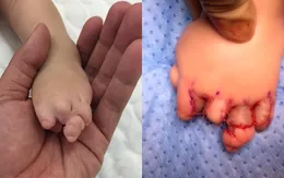 Mắc bệnh lạ: Ngón tay, ngón chân của bé gái dính chặt vào nhau