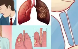 Bạn có mắc triệu chứng này của ung thư phổi?