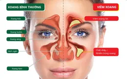 Bệnh viêm xoang nguy hiểm như thế nào?