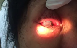 Người phụ nữ bị chồng bạo hành vỡ nhãn cầu