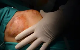 Mang khối u bằng bàn tay trước ngực vì tự điều trị bằng thuốc nam