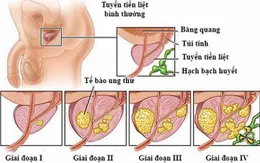 Điều trị ung thư tuyến tiền liệt di căn