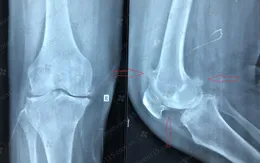 Ca phẫu thuật thay khớp gối cho bệnh nhân bị đau gối suốt 7 năm