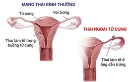 Dấu hiệu nào cho thấy bạn đang mang thai ngoài tử cung?