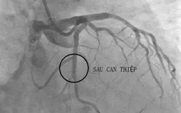 Nguy cơ tái hẹp sau đặt stent mạch vành