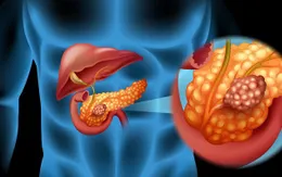 Điểm mặt những nhóm người dễ mắc ung thư tuyến tụy