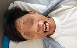 Bị cứng hàm mất cảm giác chân do uốn ván