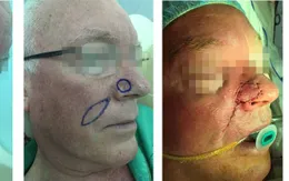 Tạo hình thành công cho nhiều bệnh nhân khuyết hổng vùng đầu mặt cổ