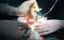 Vòi xịt nước dài 45cm mắc kẹt trong hậu môn nam thanh niên