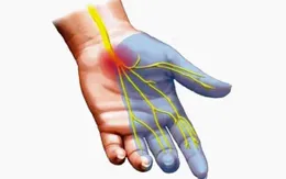 Những điều cần biết về hội chứng ống cổ tay