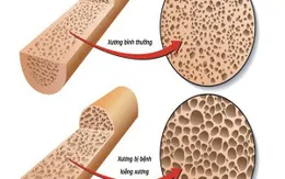 Nguyên nhân và triệu chứng bệnh loãng xương
