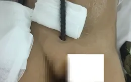 Ngã vào trụ sắt chuồng gà, bé trai bị thanh sắt đâm xuyên bụng