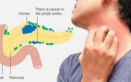 Giải đáp thắc mắc về ung thư tuyến tụy