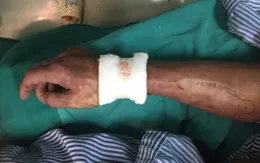 Người đàn ông bị đứt động mạch, dây thần kinh do tai nạn lao động