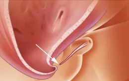 Vì sao trẻ bị tật lỗ tiểu thấp?