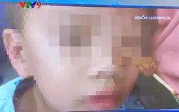 TP.HCM: Hai trẻ bị que xiên thịt cắm sâu vào hốc mắt