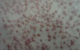 Mụn trứng cá - Phân loại để dễ điều trị