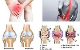 Bệnh viện Bạch Mai: Khám, tư vấn miễn phí các bệnh cơ xương khớp