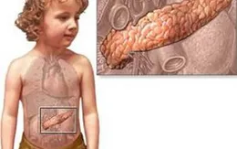 Viêm tụy cấp - bệnh nguy hiểm ở trẻ