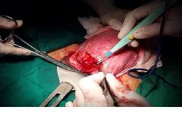 Đẻ tại nhà, sản phụ bị vỡ tử cung nguy kịch