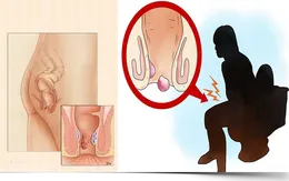 Đắp thuốc nam chữa trĩ: Hai phụ nữ cầu cứu bác sĩ vì bị hoại tử hậu môn