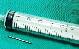 Lấy cây kim dài 2cm trong khuỷu tay bé trai 12 tuổi