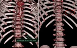 Cứu bé gái bị đạn súng hơi bắn xuyên vào ngực trái