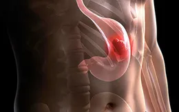 Biểu hiện của ung thư dạ dày theo mỗi giai đoạn của bệnh