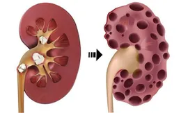 Suy thận và những điều cần biết